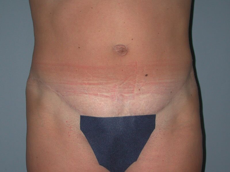After — Tummy Tuck, Abdominoplasty