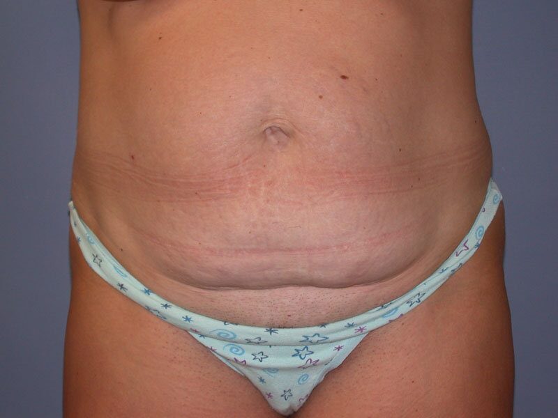 Before — Tummy Tuck, Abdominoplasty