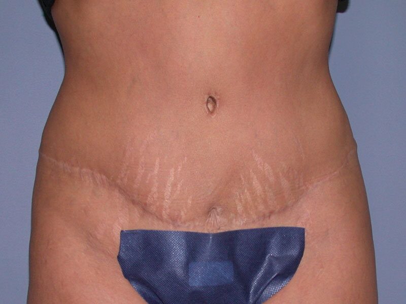 After — Tummy Tuck, Abdominoplasty