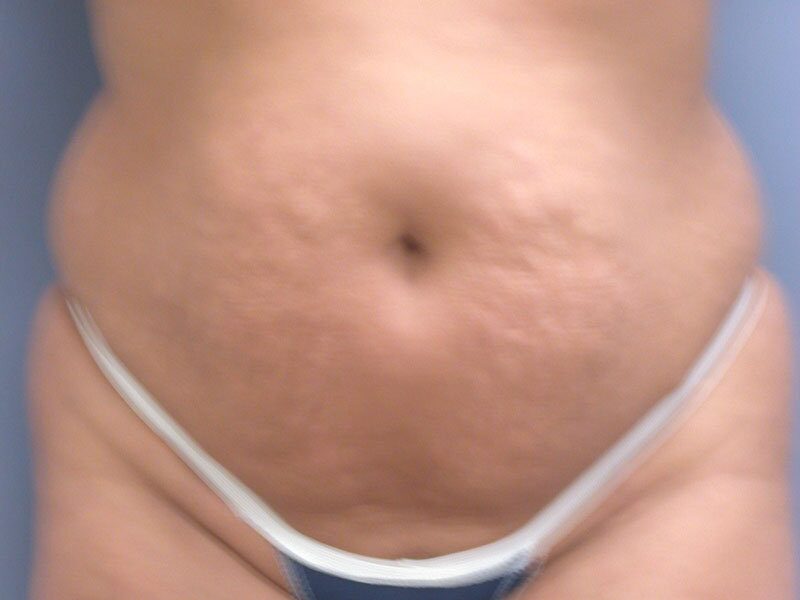 Before — Tummy Tuck, Abdominoplasty