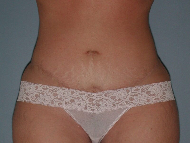 After — Tummy Tuck, Abdominoplasty