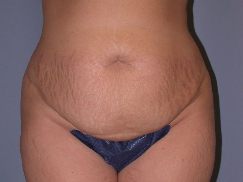 Before — Tummy Tuck, Abdominoplasty