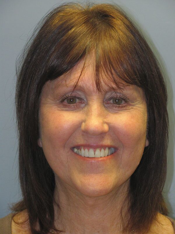 After — Neck Lift, Platysmaplasty