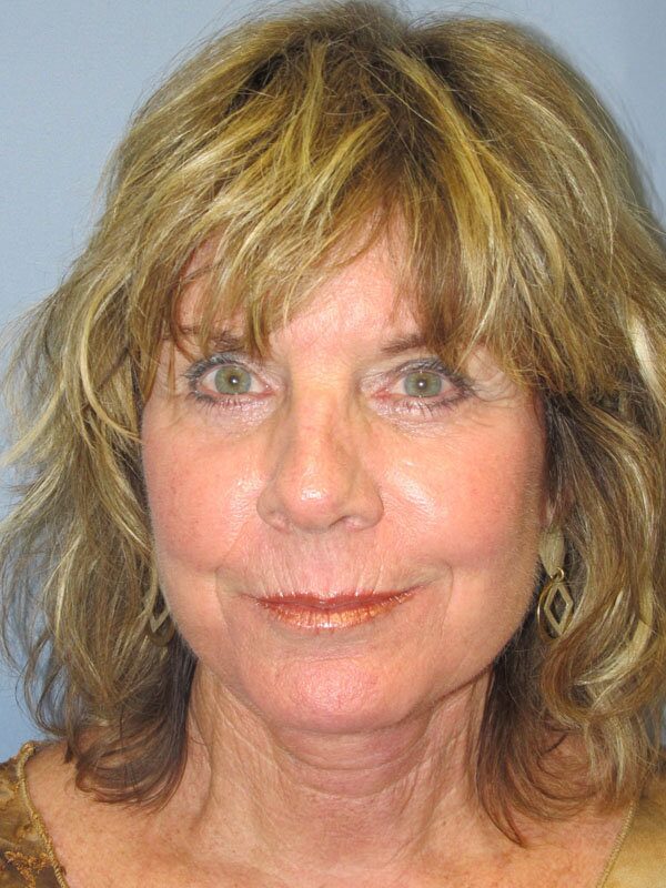 After — Neck Lift, Platysmaplasty