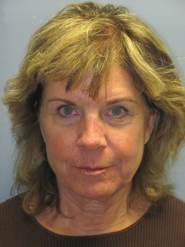 Before — Neck Lift, Platysmaplasty