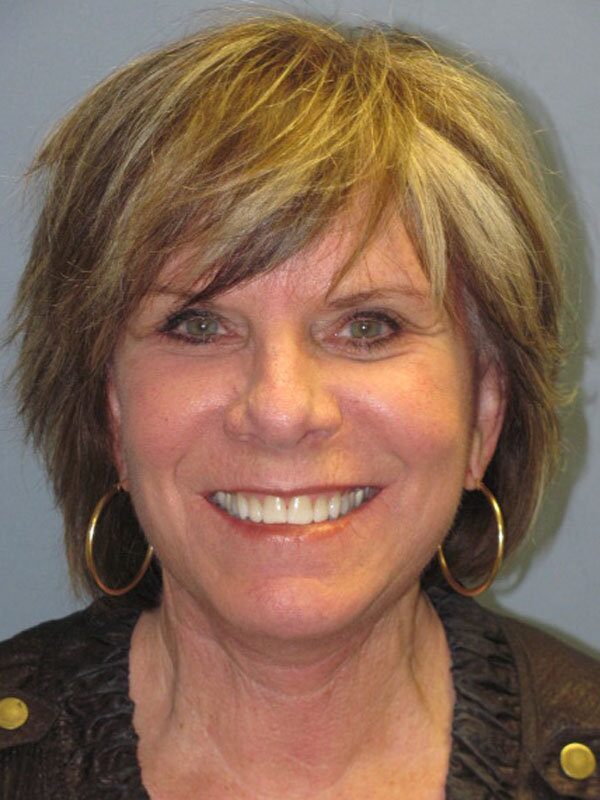 After — Neck Lift, Platysmaplasty