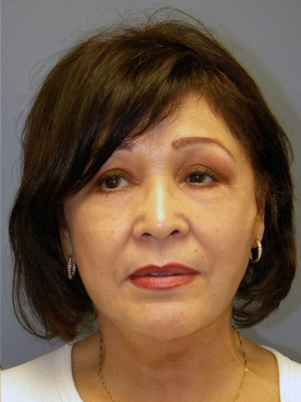 After — Neck Lift, Platysmaplasty