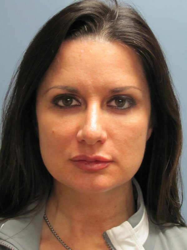 Before — Neck Lift, Platysmaplasty
