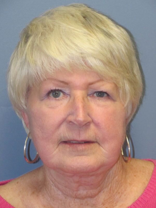 After — Neck Lift, Platysmaplasty