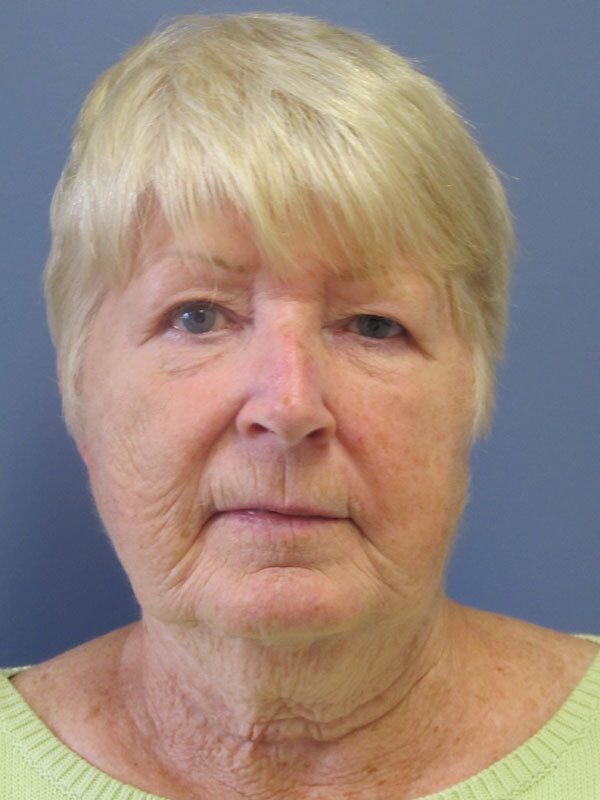 Before — Neck Lift, Platysmaplasty