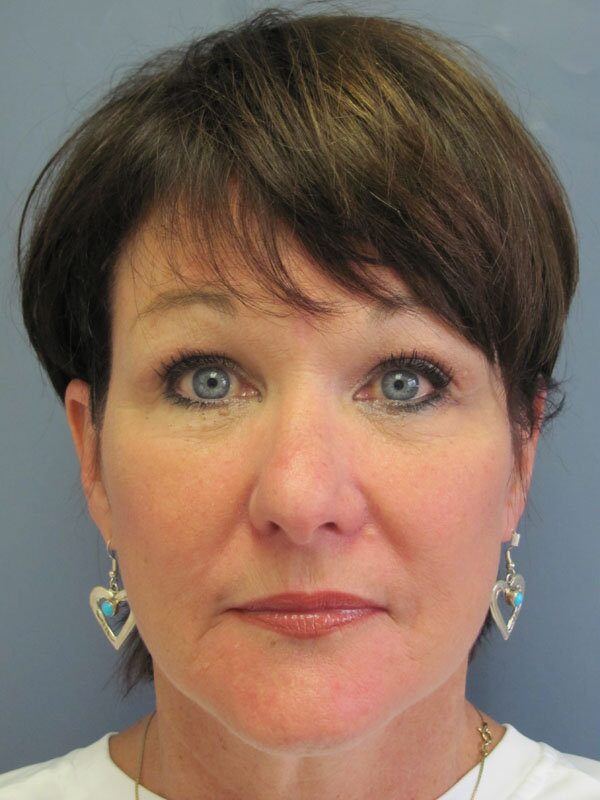 After — Neck Lift, Platysmaplasty