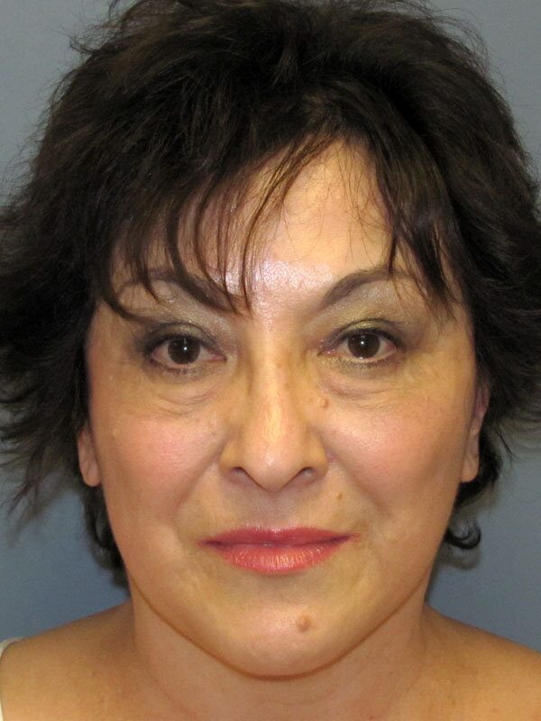 After — Neck Lift, Platysmaplasty