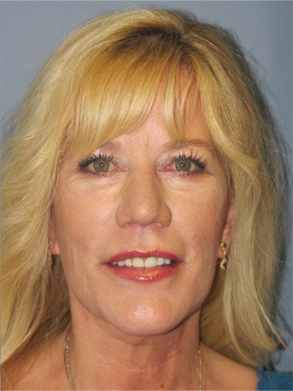 After — Neck Lift, Platysmaplasty