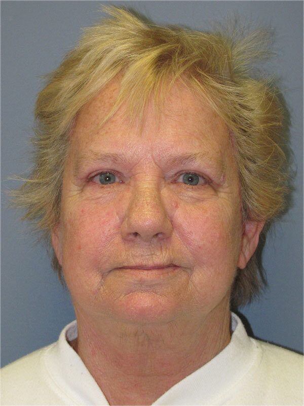 After — Neck Lift, Platysmaplasty