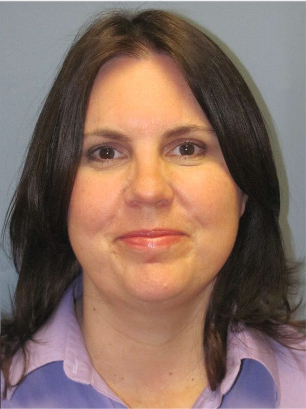 After — Neck Lift, Platysmaplasty
