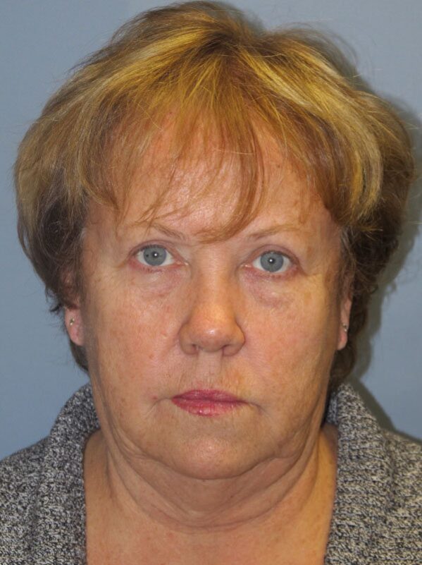 Before — Neck Lift, Platysmaplasty