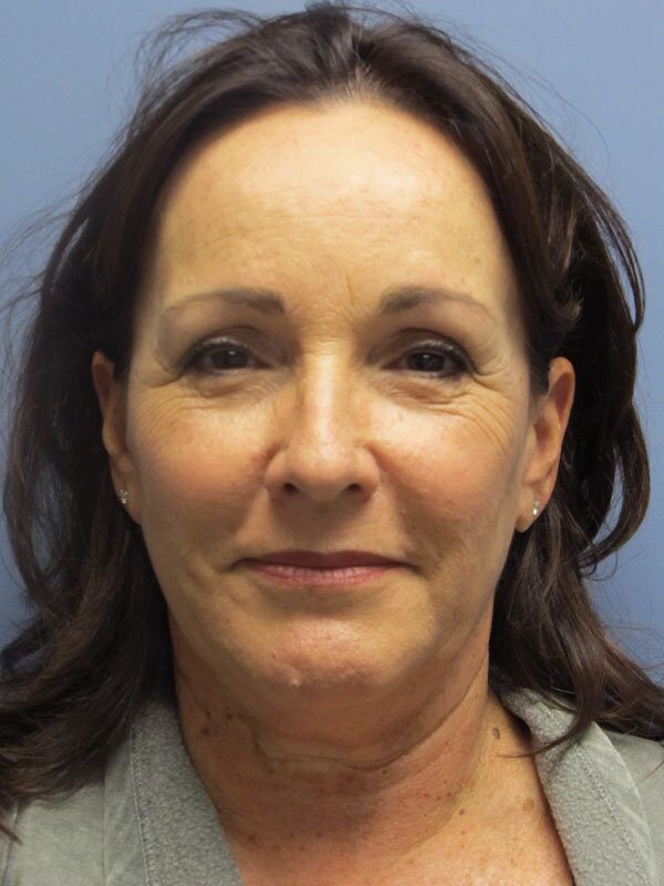Before — Neck Lift, Platysmaplasty