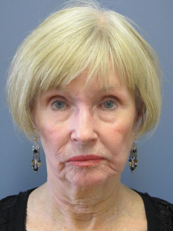 Before — Neck Lift, Platysmaplasty