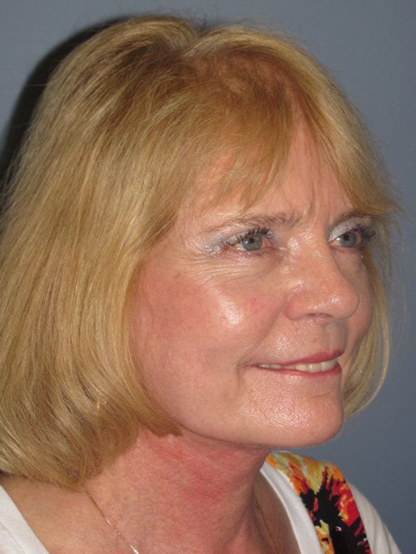 After — Neck Lift, Platysmaplasty