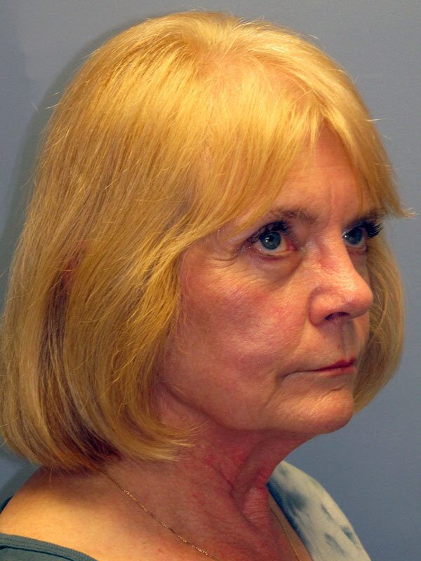 Before — Neck Lift, Platysmaplasty
