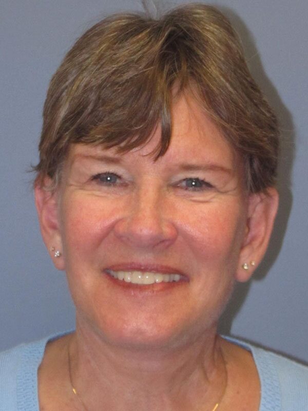 After — Neck Lift, Platysmaplasty