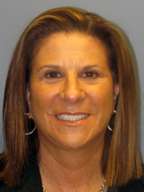 After — Neck Lift, Platysmalasty