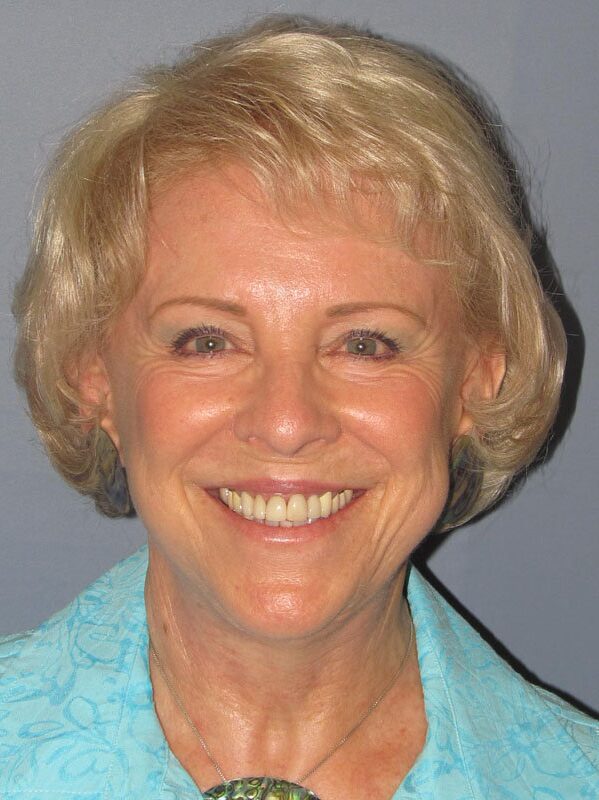 After — Neck Lift, Platysmaplasty