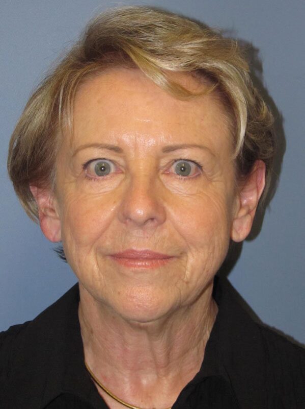 Before — Neck Lift, Platysmaplasty