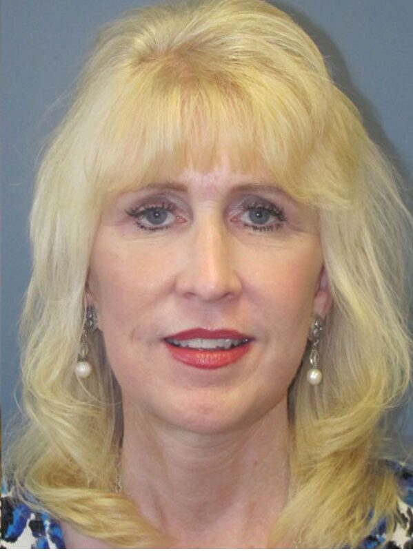 After — Neck Lift, Platysmaplasty