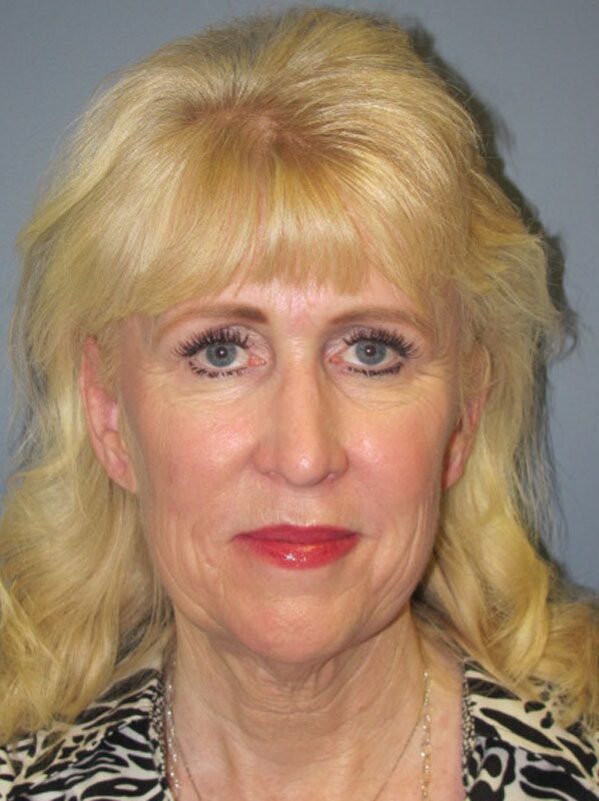 Before — Neck Lift, Platysmaplasty