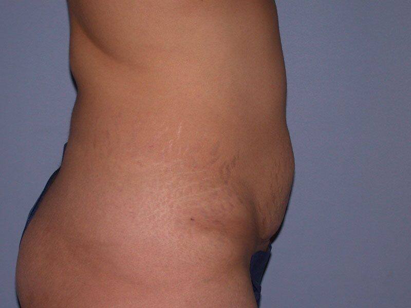 Before — Mommy Makeover