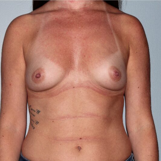Before — Breast Augmentation with Ideal Implants