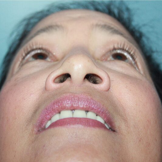 Before — Female treated with a Nose Surgery