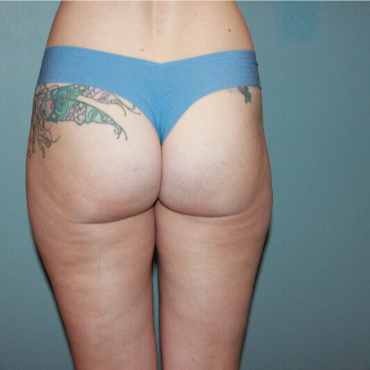 After — 37year old woman treated with Cellfina for cellulite
