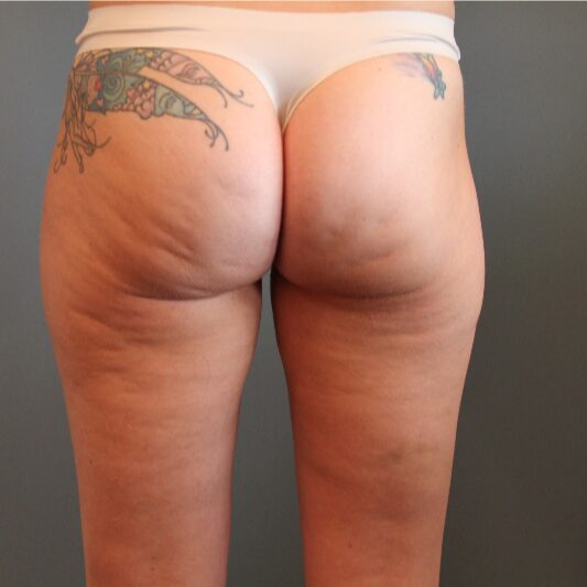 Before — 37year old woman treated with Cellfina for cellulite