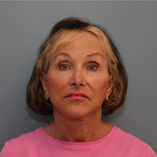 After — 74 year old woman treated with Lower Face Lift