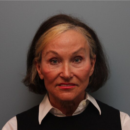 Before — 74 year old woman treated with Fat Transfer