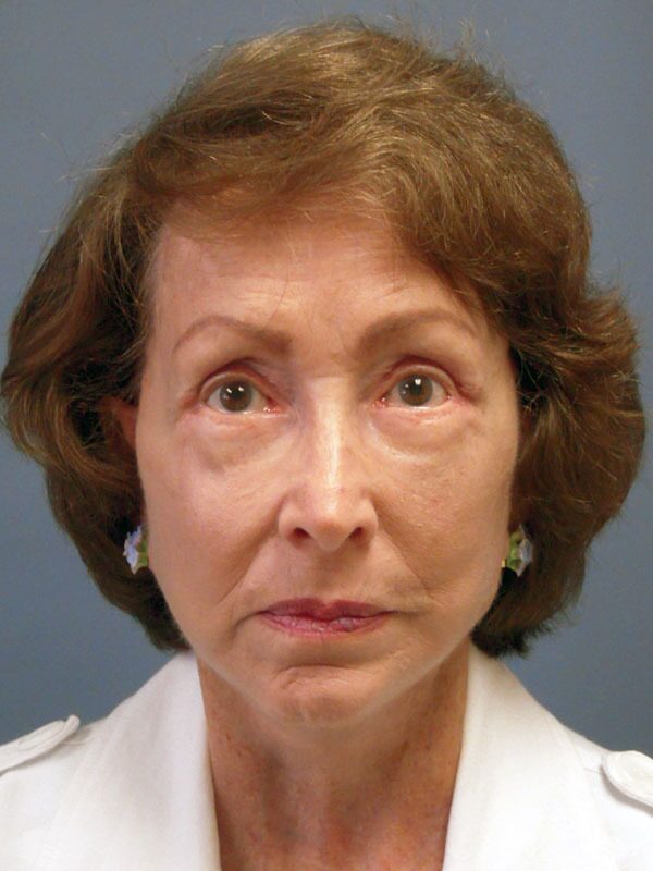 After — LiteLift, SMAS lift, mini lift