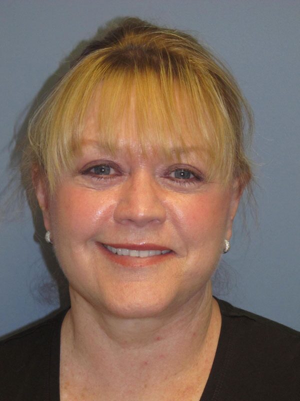 After — LiteLift, SMAS Facelift, Mini Lift