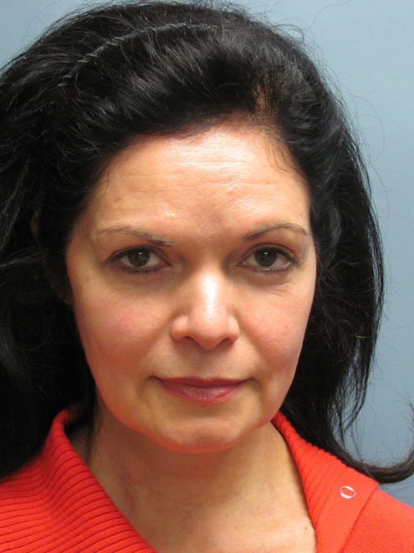 Before — SMAS Facelift, LiteLift, Mini Lift