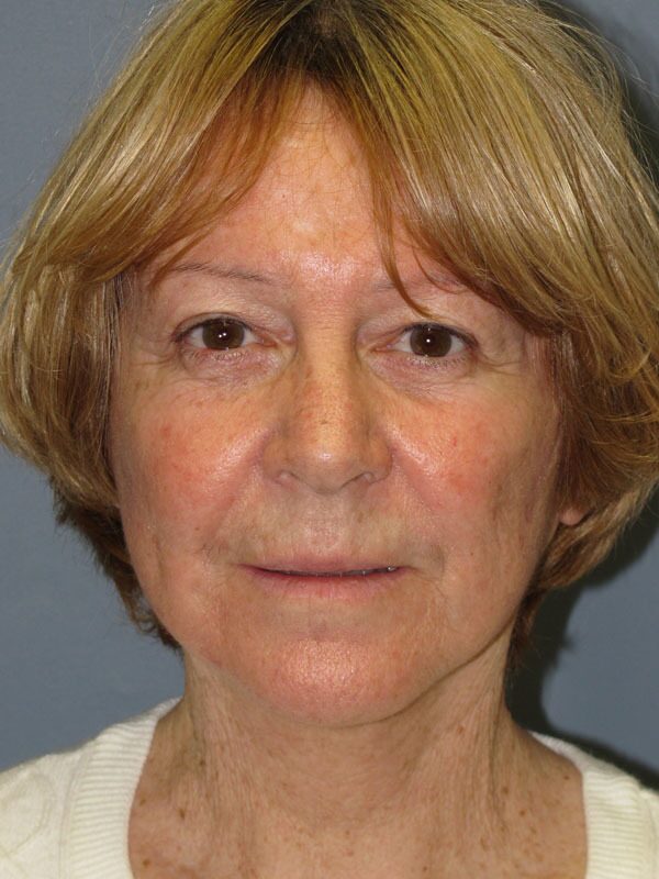 After — SMAS Facelift, LiteLift, Mini Lift