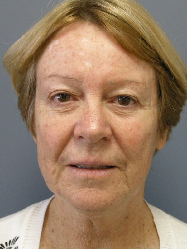Before — SMAS Facelift, LiteLift, Mini Lift