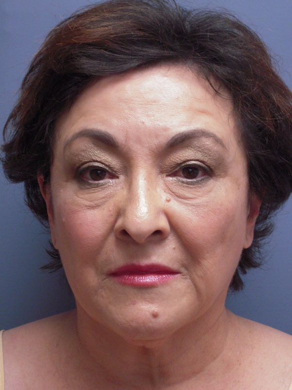 Before — SMAS Facelift, LiteLift, Mini Lift