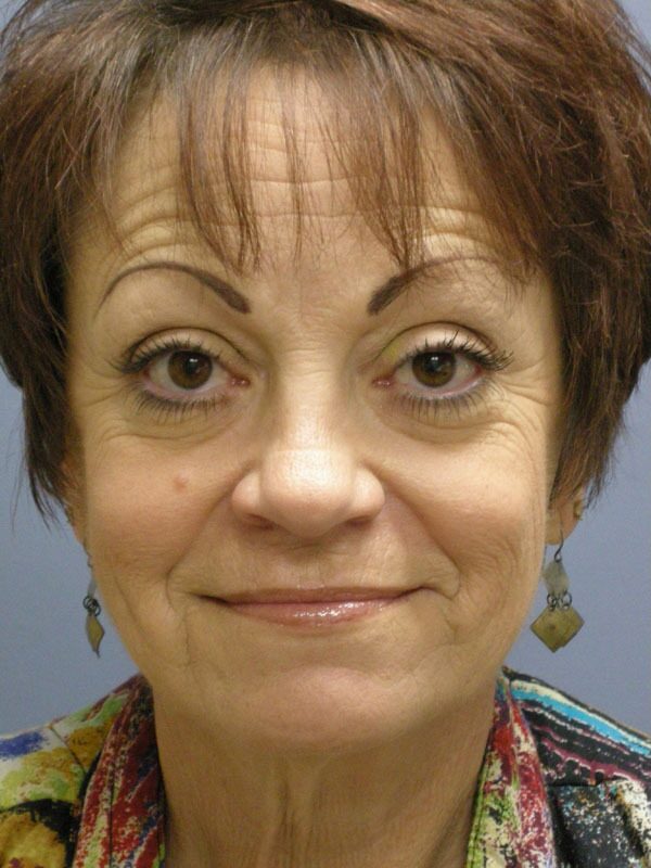 Before — SMAS Facelift, LiteLift, Mini Lift