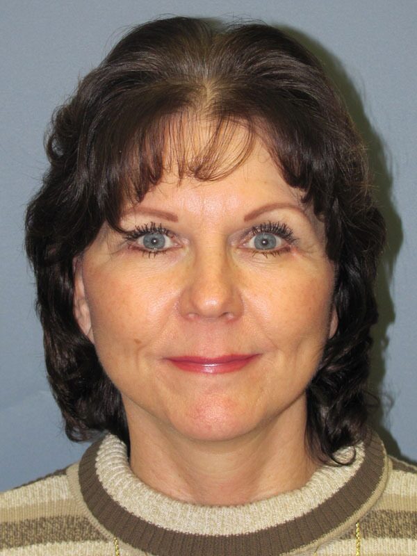 After — SMAS Facelift, LiteLift, Mini Lift