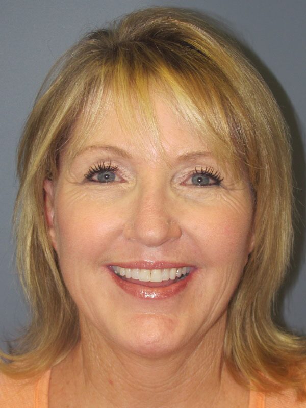 After — SMAS Facelift, LiteLift, Mini Lift