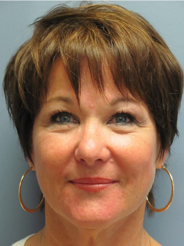 Before — SMAS Facelift/LiteLift/Mini Lift 