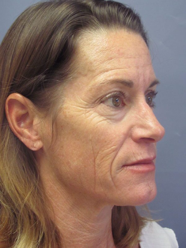 Before — SMAS Facelift/LiteLift, Mini Lift