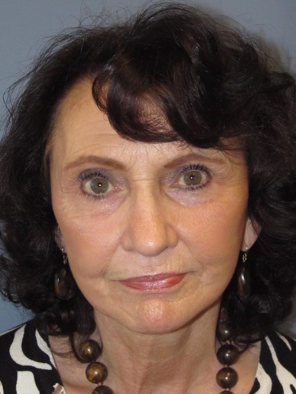 After — SMAS Facelift/LiteLift/Mini Lift