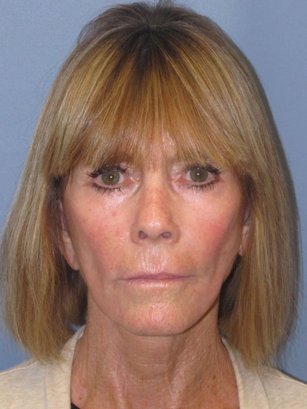 After — SMAS Facelift/LiteLift/Mini Lift